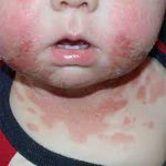 مشکلات پوستی کودکان؛ علل، علائم، تشخیص و درمان