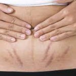 درمان ترک های پوستی ناشی از بارداری و چاقی